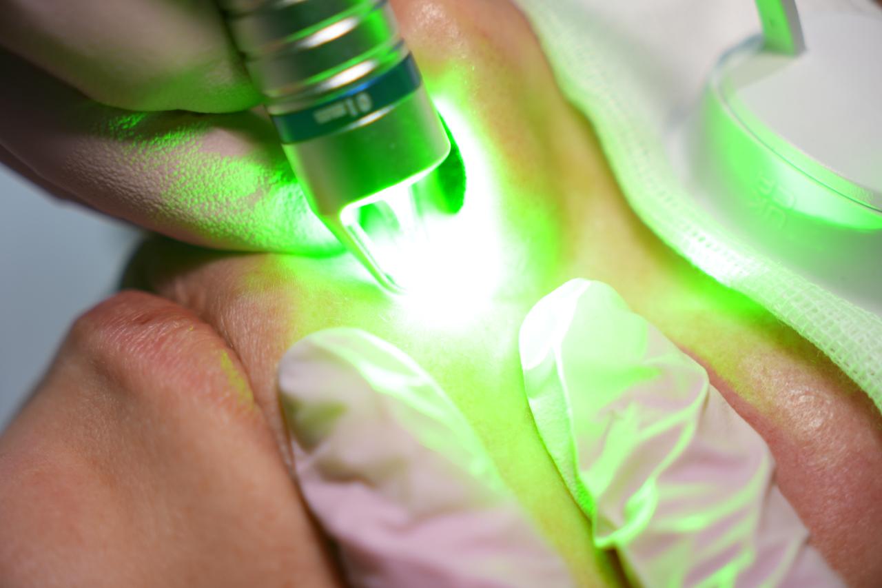 ELVii KTP-laserbehandling hos Vital Laserklinik